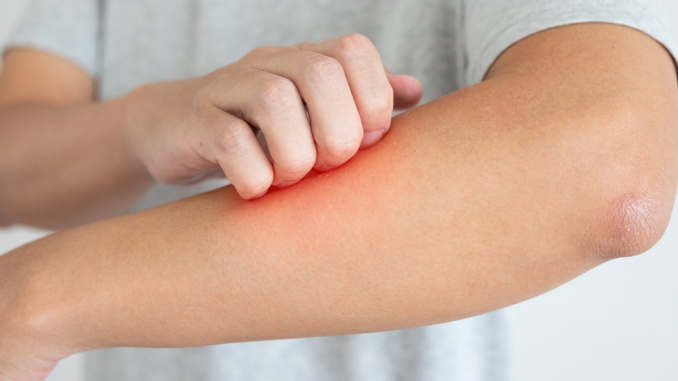 Young asian man itching and scratching on arm from itchy dry ski